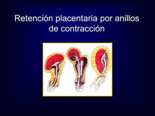Retención placentaria por anillos 
de contracción 
 