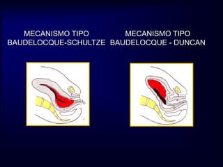 MECANISMO TIPO 
BAUDELOCQUE-SCHULTZE 
MECANISMO TIPO 
BAUDELOCQUE - DUNCAN 
 