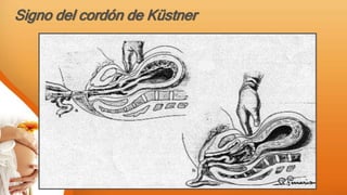 Signo del cordón de Küstner
 