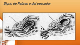 Signo de Fabres o del pescador
 