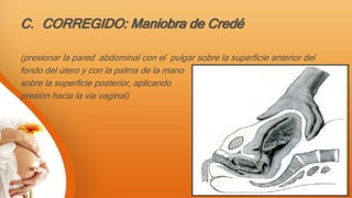 C. CORREGIDO: Maniobra de Credé
(presionar la pared abdominal con el pulgar sobre la superficie anterior del
fondo del útero y con la palma de la mano
sobre la superficie posterior, aplicando
presión hacia la vía vaginal)
 