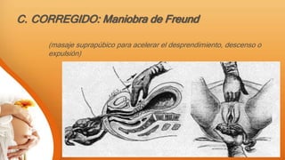 C. CORREGIDO: Maniobra de Freund
(masaje suprapúbico para acelerar el desprendimiento, descenso o
expulsión)
 