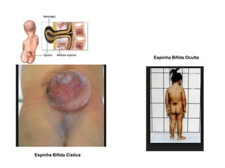 Espinha Bífida Cística
Espinha Bífida Oculta
 