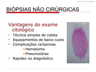 BI ÓPSIAS NÃO CIRÚRGICAS Vantagens do exame  citológico Técnica simples de coleta Equipamentos de baixo custo Complicações raríssimas  Hematoma  Pneumotórax Rapidez no diagnóstico 