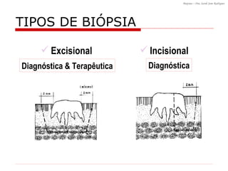 TIPOS DE BI ÓPSIA Diagnóstica Excisional Incisional Diagnóstica & Terapêutica 