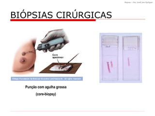 BI ÓPSIAS CIRÚRGICAS Punção com agulha grossa (core-biopsy) 