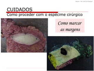Como marcar  as margens CUIDADOS Como proceder com o espécime cirúrgico 