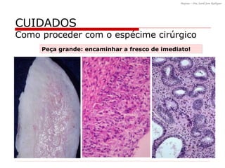 CUIDADOS Como proceder com o espécime cirúrgico Peça grande: encaminhar a fresco de imediato! 