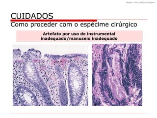 CUIDADOS Como proceder com o espécime cirúrgico Artefato por uso de instrumental inadequado/manuseio inadequado 
