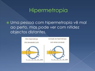             HipermetropiaUma pessoa com hipermetropia vê mal ao perto, mas pode ver com nitidez objectos distantes.