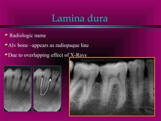 Lamina dura 
Radiologic name 
Alv bone –appears as radiopaque line 
Due to overlapping effect of X-Rays 
 