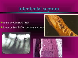 Interdental septum 
found between two teeth 
Large or Small –Gap between the teeth 
 