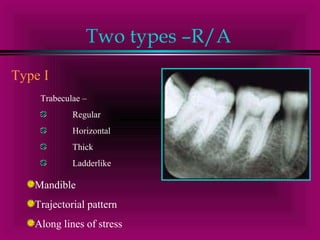 Two types –R/A 
Type I 
Trabeculae – 
Regular 
Horizontal 
Thick 
Ladderlike 
Mandible 
Trajectorial pattern 
Along lines of stress 
 
