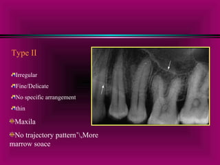 Type II 
Irregular 
Fine/Delicate 
No specific arrangement 
thin 
Maxila 
No trajectory pattern’,More 
marrow soace 
 