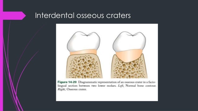 Alveolar bone
