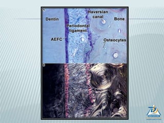 ALVEOLAR BONE (PROCESS)
 Definition: alveolar process is that
part of maxilla and mandible that
forms and supports the sockets of
teeth.
 Development: it starts in the
second month of fetal life
 Maxilla and mandible forms a
groove that is open towards the
surface of the oral cavity.
Developing tooth buds are enclosed
in these grooves.
 Major portion of the alveolar process
begins with root formation and
eruption of the teeth.
 During rapid growth alveolar crest
shows characteristics of cartilage
and bone - CHONDROID BONE
 