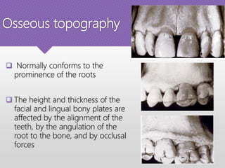 Osseous topography
 Normally conforms to the
prominence of the roots
 The height and thickness of the
facial and lingual bony plates are
affected by the alignment of the
teeth, by the angulation of the
root to the bone, and by occlusal
forces
 