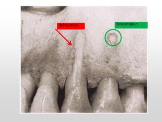fenestrationdehiscence
 