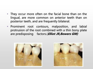 • They occur more often on the facial bone than on the
lingual, are more common on anterior teeth than on
posterior teeth, and are frequently bilateral.
• Prominent root contours, malposition, and labial
protrusion of the root combined with a thin bony plate
are predisposing factors.(Elliot JR,Bowers GM)
 