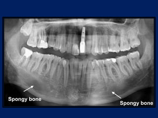 Spongy bone
Spongy bone
 