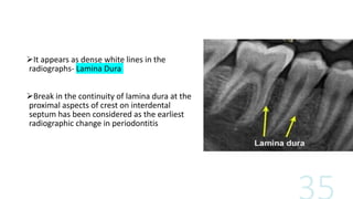 It appears as dense white lines in the
radiographs- Lamina Dura
Break in the continuity of lamina dura at the
proximal aspects of crest on interdental
septum has been considered as the earliest
radiographic change in periodontitis
 