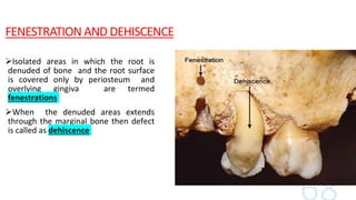 FENESTRATION AND DEHISCENCE
Isolated areas in which the root is
denuded of bone and the root surface
is covered only by periosteum and
overlying gingiva are termed
fenestrations
When the denuded areas extends
through the marginal bone then defect
is called as dehiscence
 