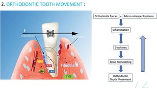 2.ORTHODONTIC TOOTH MOVEMENT
It is due to biologic plastic property
of the bone is possible to move the teeth
without disrupting their relation to the alveolar
bone. Bone is resorbed in pressure side and formed
on the tension side.
At the site of alveolar bone compression ,osteoclasts
proliferate and resorption of the superficial bone
takes place. While at site of tension ,osteoblasts are
activated to produce osteoid that subsequently
mineralize to form new bone
2. ORTHODONTIC TOOTH MOVEMENT :
 