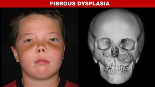 FIBROUS DYSPLASIA
 