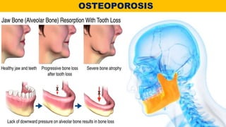 OSTEOPOROSIS
 