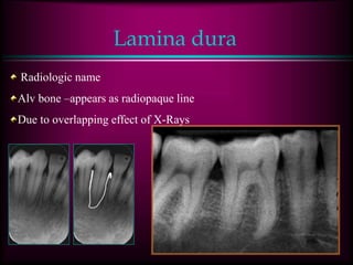 Lamina dura
Radiologic name
Alv bone –appears as radiopaque line
Due to overlapping effect of X-Rays
 