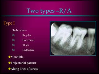 Two types –R/A
Type I
Trabeculae –
Regular
Horizontal
Thick
Ladderlike
Mandible
Trajectorial pattern
Along lines of stress
 