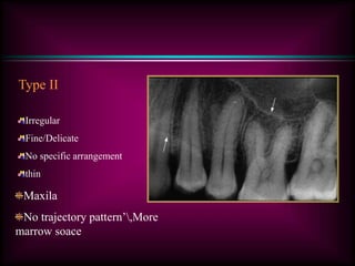 Type II
Irregular
Fine/Delicate
No specific arrangement
thin
Maxila
No trajectory pattern’,More
marrow soace
 