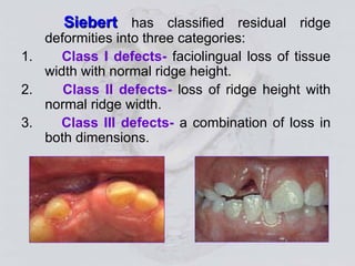 Siberet Ridge Defect Alveolar Bone basic terminologies and concept.ppt