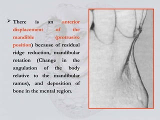 Alveolar Bone and prosthodontics relevance | PPT