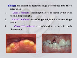 Siberet Ridge Defect Alveolar Bone and prosthodontics relevance | PPT