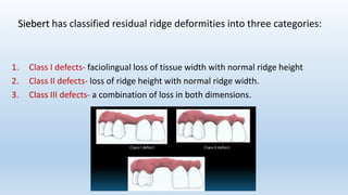 Alveolar bone in prosthodontics | PPTX