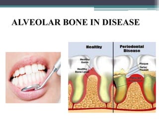 ALVEOLAR BONE IN DISEASE
 