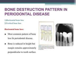 BONE DESTRUCTION PATTERN IN
PERIODONTAL DISEASE
1)Horizontal bone loss
2)Vertical bone loss
Horizontal bone loss:
■ Most common pattern of bone
loss in periodontal disease.
■ Bone is reduced in height but
margin remains approximately
perpendicular to tooth surface.
 