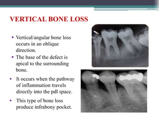 VERTICAL BONE LOSS
 Vertical/angular bone loss
occurs in an oblique
direction.
 The base of the defect is
apical to the surrounding
bone.
 It occurs when the pathway
of inflammation travels
directly into the pdl space.
 This type of bone loss
produce infrabony pocket.
 