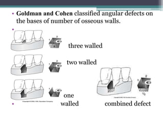 • Goldman and Cohen classified angular defects on
the bases of number of osseous walls.
•
•
• three walled
•
• two walled
• one
• walled combined defect
 