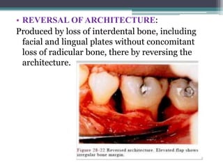 • REVERSAL OF ARCHITECTURE:
Produced by loss of interdental bone, including
facial and lingual plates without concomitant
loss of radicular bone, there by reversing the
architecture.
 