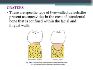 CRATERS
• These are specific type of two-walled defects;the
present as concavities in the crest of interdental
bone that is confined within the facial and
lingual walls.
 
