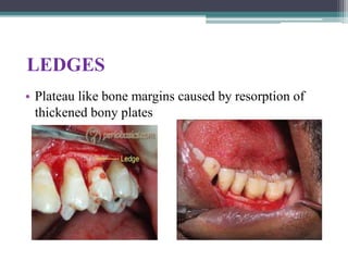 LEDGES
• Plateau like bone margins caused by resorption of
thickened bony plates
 