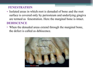 FENESTRATION
• Isolated areas in which root is denuded of bone and the root
surface is covered only by periosteum and underlying gingiva
are termed as fenestration. Here the marginal bone is intact.
DEHISCENCE
• When the denuded areas extend through the marginal bone,
the defect is called as dehiscence.
 
