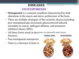 DISEASES
OSTEOPOROSIS
• Osteoporosis is a common condition characterized by both
alterations in the macro and micro architecture of the bone.
• There are multiple etiologies of this systemic disease,including
post menopausal,age associated, glucocorticoid induced,
secondary to cancer, androgen ablation, and aromatase
inhibitors (Kanis 2002).
• All these forms result in decrease in strength and cause
fractures.
• Post menopausal osteoporosis is the most common cause.
• There is a decrease in bone mineral density.
 