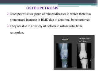 OSTEOPETROSIS
Osteopetrosis is a group of related diseases in which there is a
pronounced increase in BMD due to abnormal bone turnover.
They are due to a variety of defects in osteoclastic bone
resorption.
 