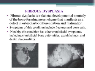 FIBROUS DYSPLASIA
• Fibrous dysplasia is a skeletal developmental anomaly
of the bone-forming mesenchyme that manifests as a
defect in osteoblastic differentiation and maturation
• Symptoms of this condition include fractures and bone pain.
• Notably, this condition has other craniofacial symptoms,
including craniofacial bone deformities, exophthalmos, and
dental abnormalities.
 