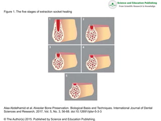 Figure 1. The five stages of extraction socket healing
Alaa Abdelhamid et al. Alveolar Bone Preservation. Biological Basis and Techniques. International Journal of Dental
Sciences and Research, 2017, Vol. 5, No. 3, 56-68. doi:10.12691/ijdsr-5-3-3
© The Author(s) 2015. Published by Science and Education Publishing.
 