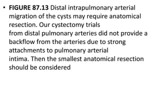 • FIGURE 87.13 Distal intrapulmonary arterial
migration of the cysts may require anatomical
resection. Our cystectomy trials
from distal pulmonary arteries did not provide a
backflow from the arteries due to strong
attachments to pulmonary arterial
intima. Then the smallest anatomical resection
should be considered
 