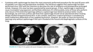 • Cystotomy with capitonnage has been the most commonly performed procedure for the past 60 years with
acceptable cure rates and perioperative morbidity. The literature suggests that capitonnage has been
performed since 1952 with the intention to decrease the rate of empyema and postoperative prolonged
airleak. However, this view has been questioned by several groups. In fact, capitonnage is reported to
cause incomplete lung expansion and facilitate atelectasis.51 Unfortunately, some of those who perform
only closure of the bronchial openings without a capitonnage have failed to produce better results.
Accordingly, we and many authors still think that capitonnage should not be abandoned when treating
deeply located intraparenchymal HCD. In this context, meticulous surgical technique is mandatory to
avoid inadvertent obliteration of the neighboring bronchi. However, we prefer to close the bronchial
openings only without capitonnage if the cyst is located at the fissural and diaphragmatic surfaces of the
lungs
 